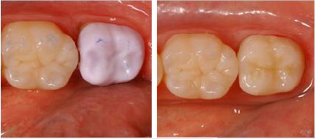All-ceramic restoration detail on a dental model