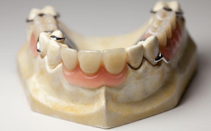 Upper cast partial denture framework on a dental model