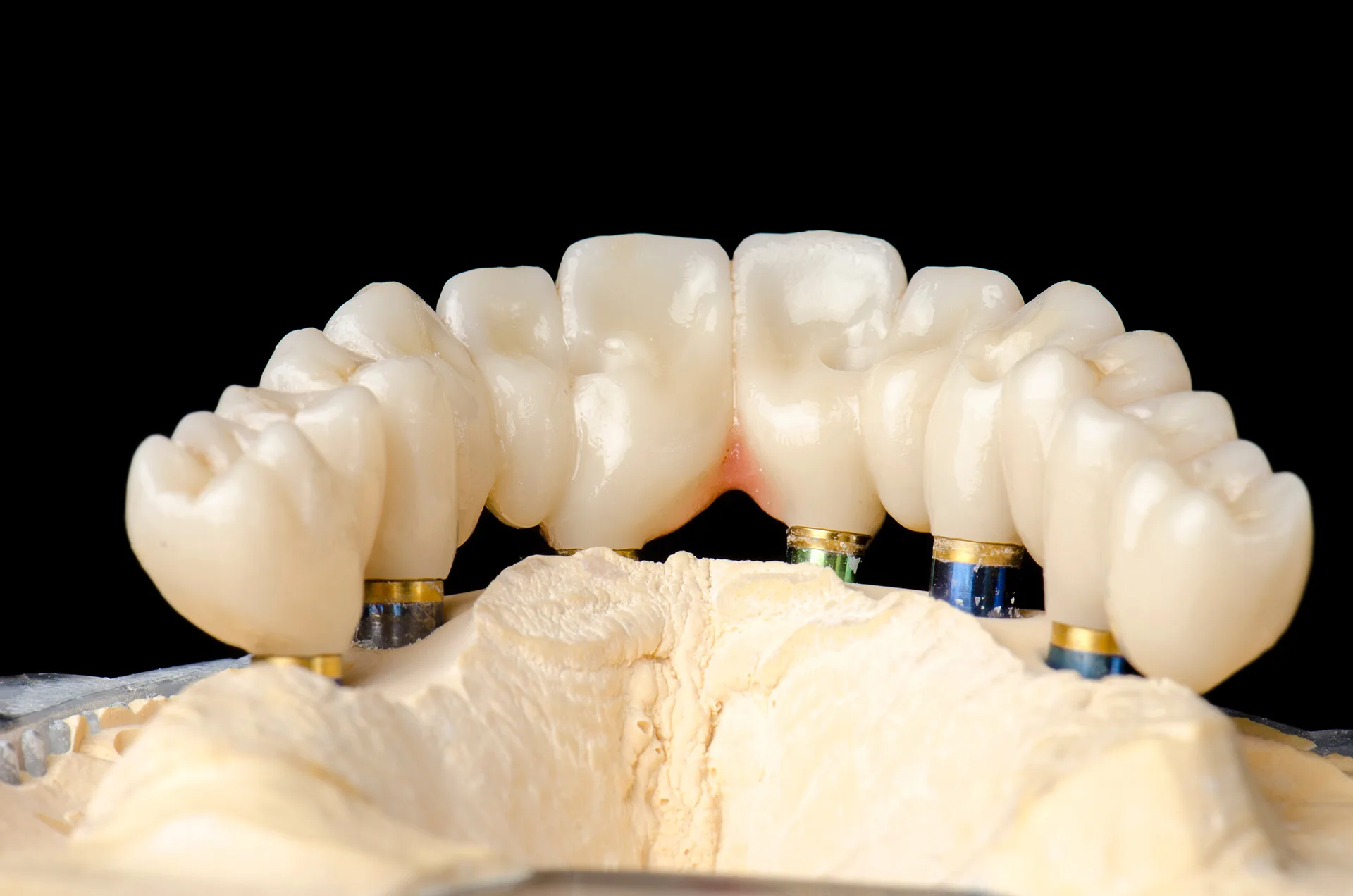 Full-arch implant restoration image