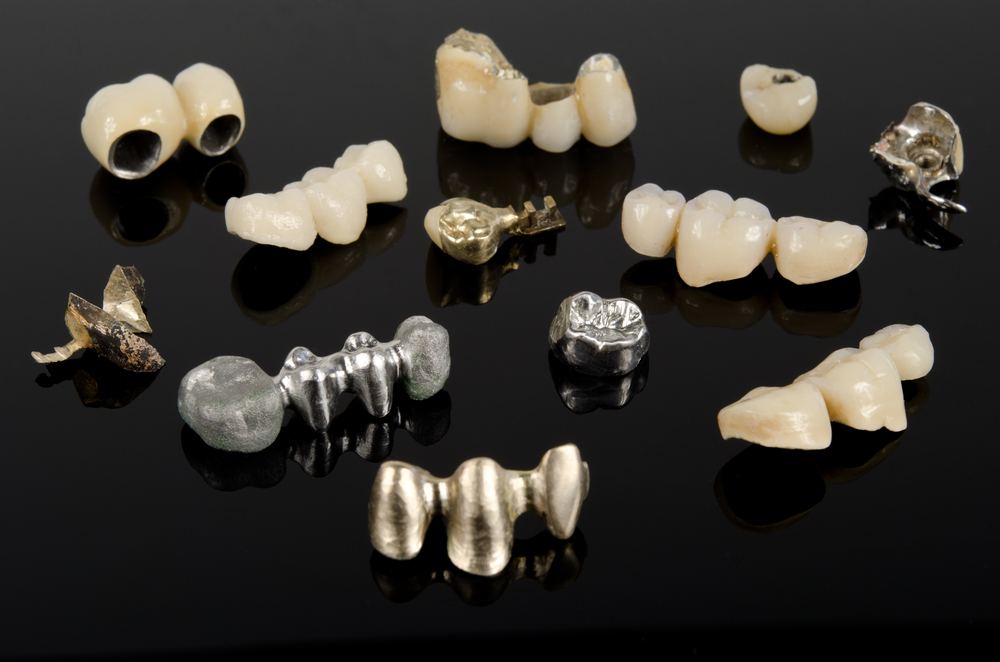 PFM crown restoration on a laboratory model